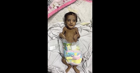 Two-month-old baby, Ahmad Bahaa Tulaib, who died from malnutrition in the Sabra neighborhood of Gaza City.