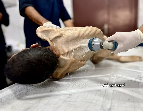 Adel Madi, 27, tragically passed away at Nasser Medical Complex in Khan Younis, succumbing to starvation, severe malnutrition, and lack of essential medicines.