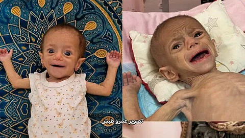 Suwar Ashour, a malnourished Palestinian child starved by Israel's ongoing blockade of Gaza.