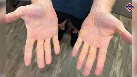 US man bizarrely leaks cholesterol from his body. It was due to his diet