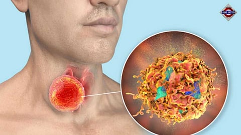 Is oral sex replacing smoking as the leading cause of throat cancer?