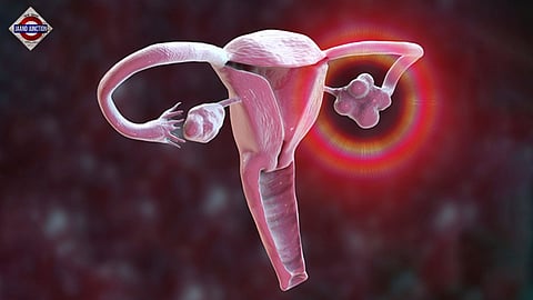 PCOS as polyendocrine metabolic ovarian syndrome (PMOS).