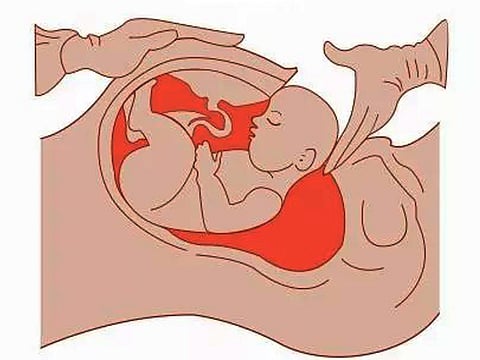 சிஸேரியனுக்கு ஒரு செக்!