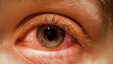 Madras Eye