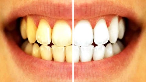 பற்களின் மஞ்சள் கறை நீங்க சில டிப்ஸ்...