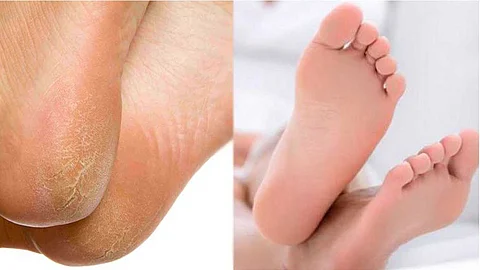 பித்த வெடிப்பு குணமாக !