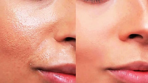 எண்ணெய் வழியும் முகத்திற்கு எளிய தீர்வுகள்