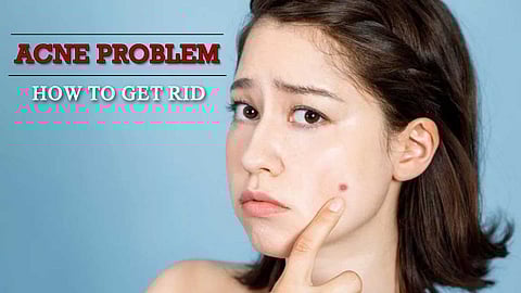 முகப்பரு தொல்லையிலிருந்து விடுபட முதலில் இத படியுங்க...!