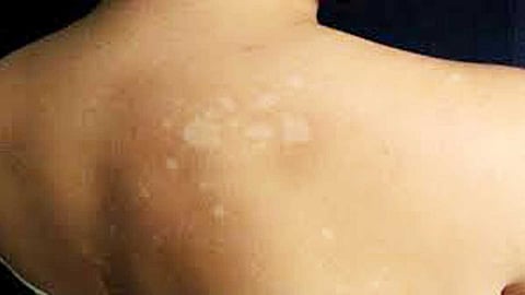 தேமலுக்கு ‘நோ’ சொல்லுங்க!