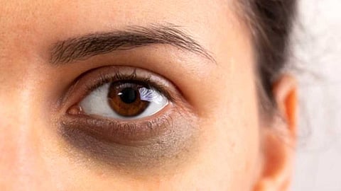 dark circles under eyes