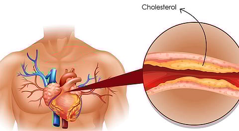 கெட்ட கொலஸ்ட்ராலை குறைக்கலாம் வாங்க!