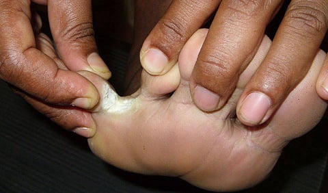 சேற்றுப்புண் ஏன் வருகிறது? வராமல் தடுக்க என்ன செய்யலாம்?