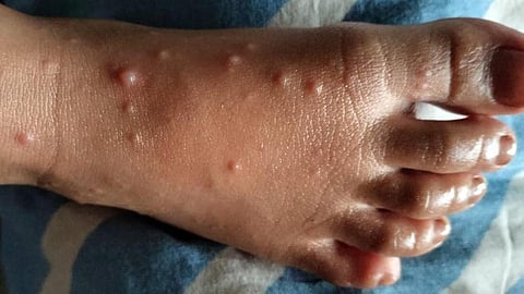 கை, பாத, வாய் நோய் என்றால் என்ன தெரியுமா?