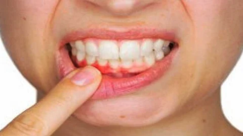yellow stains on the teeth