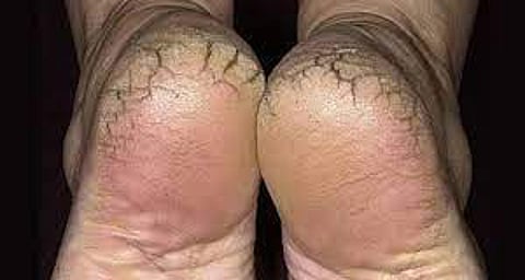 Rainy season problems and relief