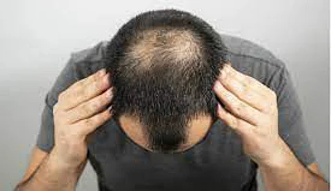 young age baldness