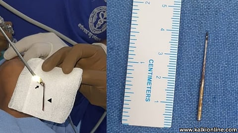 Needle stuck in the lungs, doctors used a magnet!