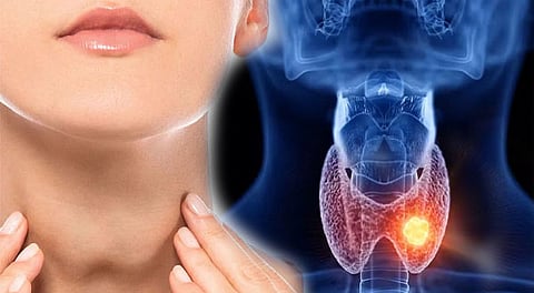 What is hypothyroidism?