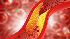 Do you know why blood vessel blockage occurs?