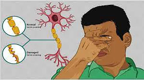 Do you know about Multiple Sclerosis?