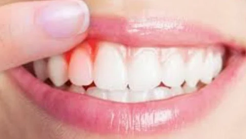 What to do if the gums suddenly bleed?