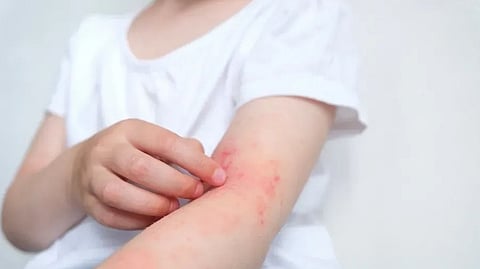 Hives allergy