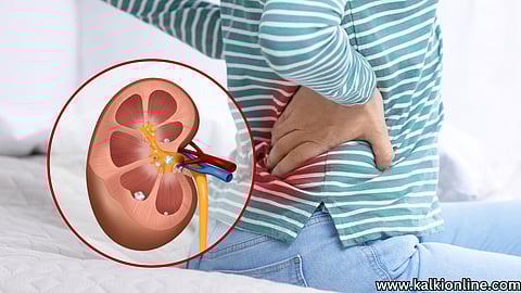 Kidney stones