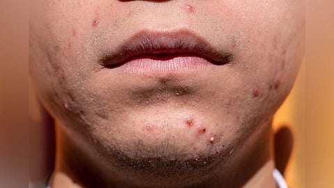 கரும்புள்ளிகளை அகற்ற...