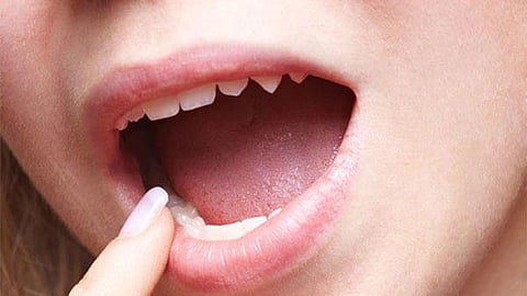 Causes and Treatments for Dry Mouth!