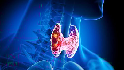 9 Foods To Avoid For People With Thyroid Problems