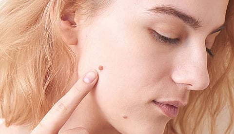 மருக்கள்