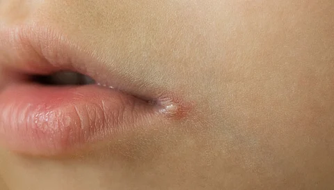 Which nutritional deficiency causes mouth ulcers?