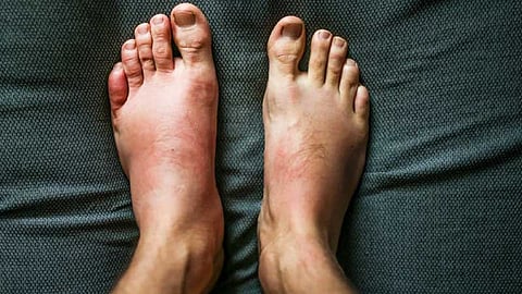 Swelling in the foot