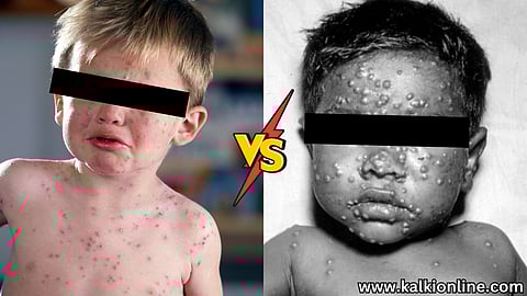 Chickenpox Vs Smallpox