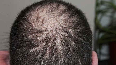 Hair loss Image...