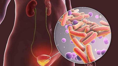 urinary infection