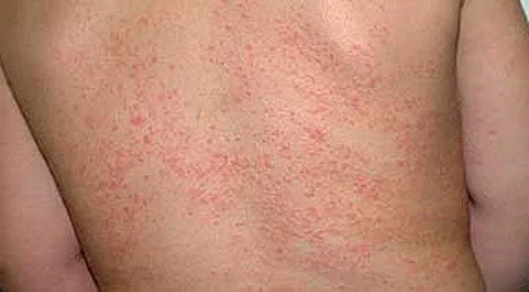 Boy with prickly heat