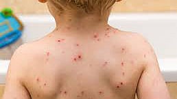 Chickenpox
