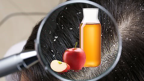 Apple Cider Vinegar and Dandruff