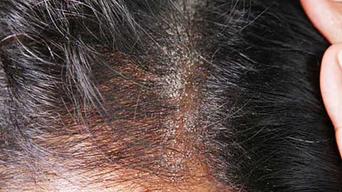 பொடுகுத் தொல்லை...