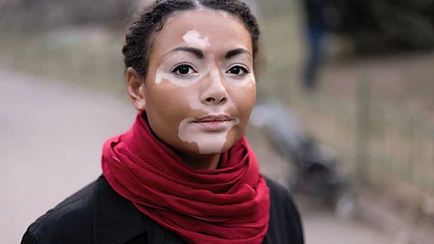 முகத்தில் வெண்புள்ளியுடன் பெண்