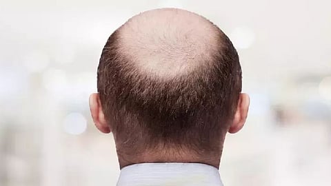 வழுக்கை தலை