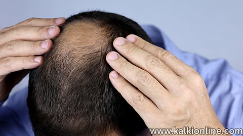 hair loss