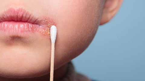 அடிக்கடி வாய் மற்றும் நாக்கில் புண் ஏற்படுகிறதா? வைட்டமின் பி6 குறைபாடாக இருக்கலாம்; ஜாக்கிரதை!