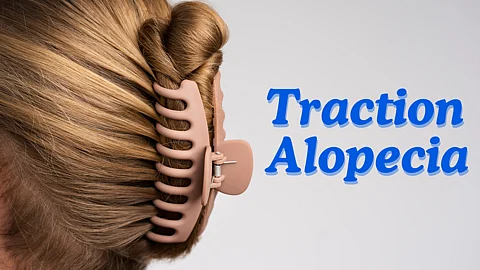 Traction Alopecia