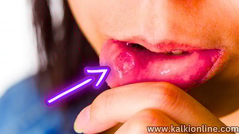 Mouth Ulcer Reasons and treatment.