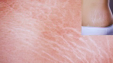 Stretch Marks