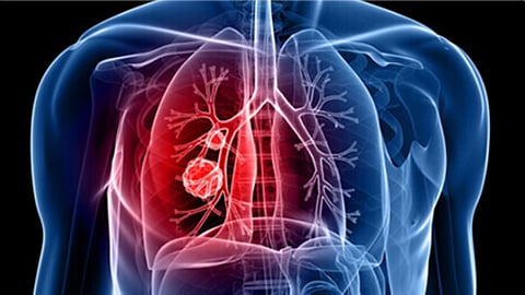 நுரையீரல் புற்றுநோய்