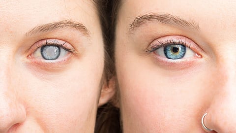 Cataract causes and cure