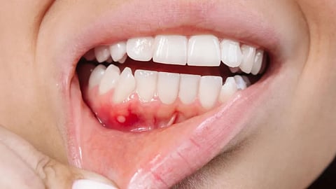 Mouth Ulcer